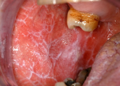 Lichen Planus