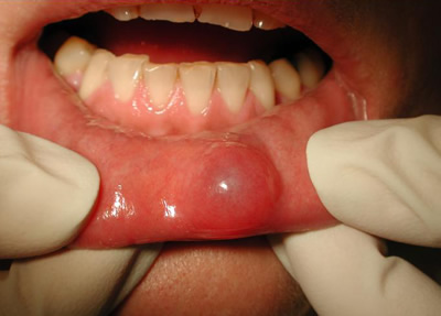 What is fibroepithelial papilloma