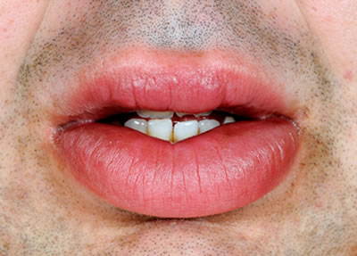 Mouth conditions - Gastrointestinal