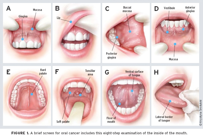 Hpv symptoms on mouth