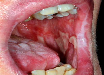 Oral Ulceration