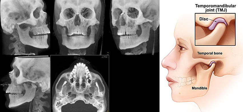 TMJ Xray